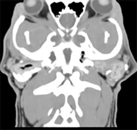 Figure 8. Tomography of the skull in brachycephalic breed which shows severe stenosis and mineralisation of external ear canal (same dog of Figure 3).