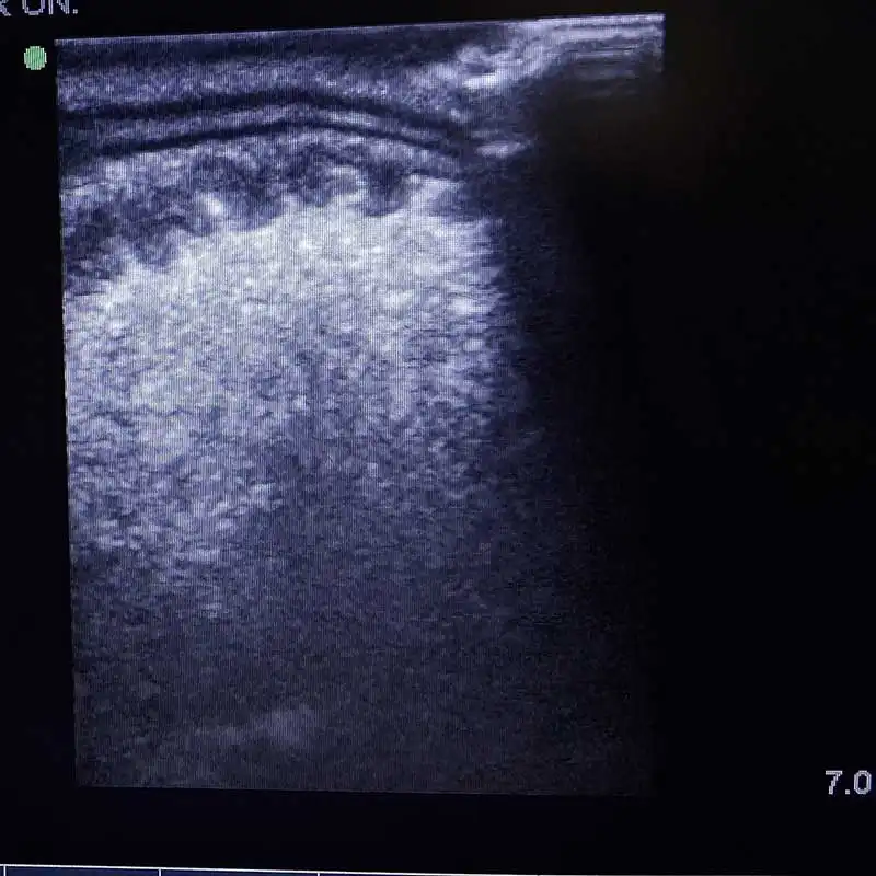 Ultrasound showing grossly thickened colonic wall.