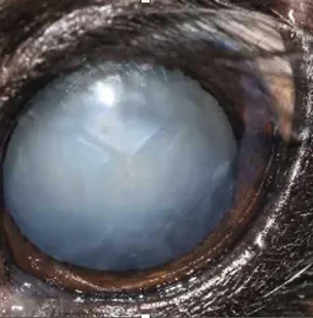 Figure 3. Diabetic cataract.
