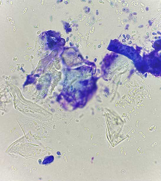 Figure 4. Cytology of the external ear canal shows corneocytes and Malassezia species overgrowth.