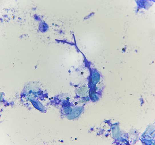 Figure 6. Cytology of the external ear canal shows neutrophils corneocytes and one septate hyphae.