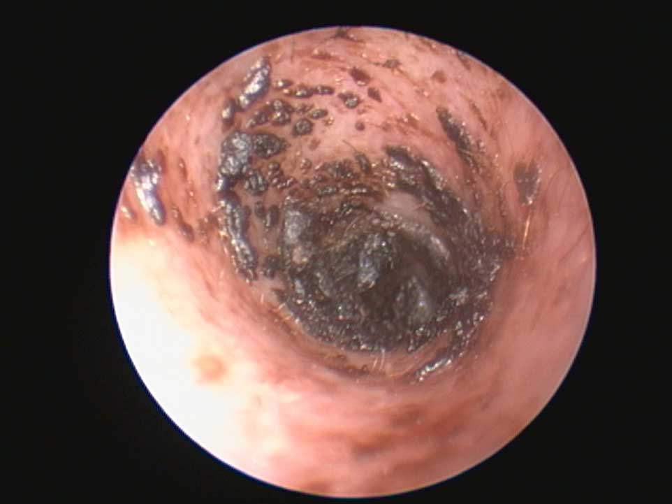Figure 7. Videoendoscopy shows obliteration of the ear canal by a large amount of cerumen in a dog affected by Malassezia species otitis.