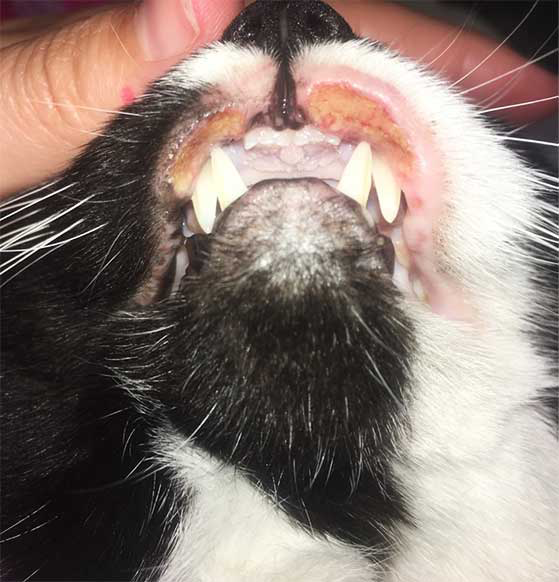 Patient with indolent ulcer on the upper lips as part of eosinophilic granuloma complex.