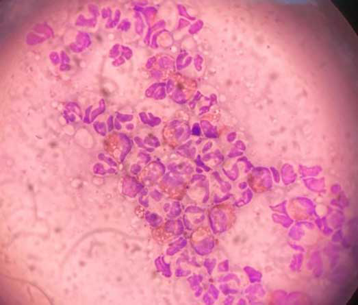 Cytology from a eosinophilic granuloma complex lesion (indolent ulcer) showing eosinophils and neutrophils. Stained with modified Romanowsky stain at ×1,000 magnification.