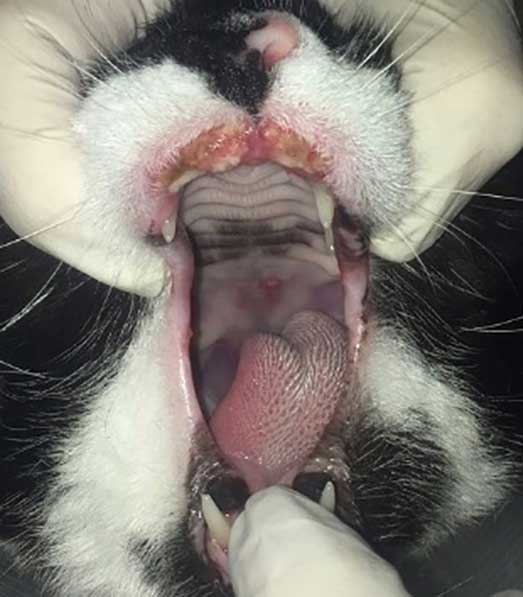 Patient with indolent ulcer on the upper lips with eosinophilic granuloma on the hard palate.