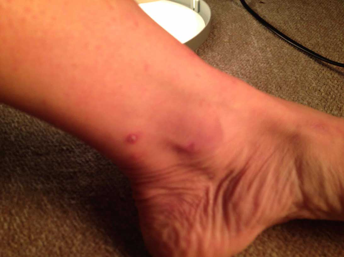 Figure 3. Flea bite reaction.