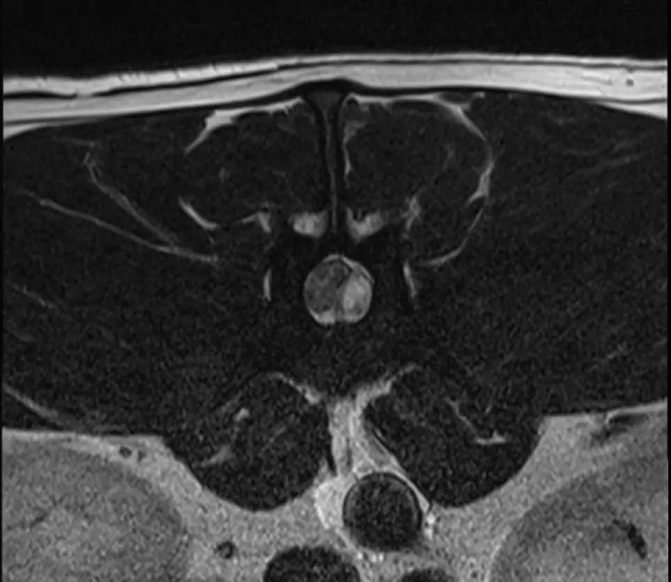 Figure 2. Transverse view of thoracolumbar intervertebral disc extrusion (type I, slightly hydrated, hence the brighter colour).