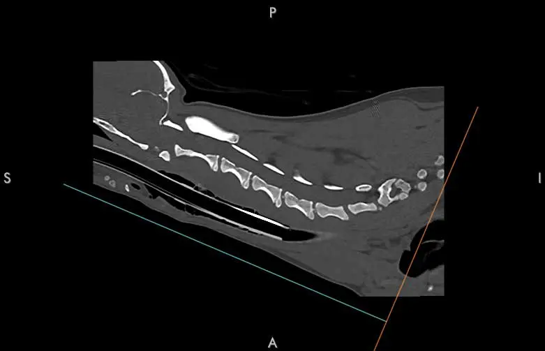 Figure 3. Saggital view of alantoaxial (AA) luxation before correction.