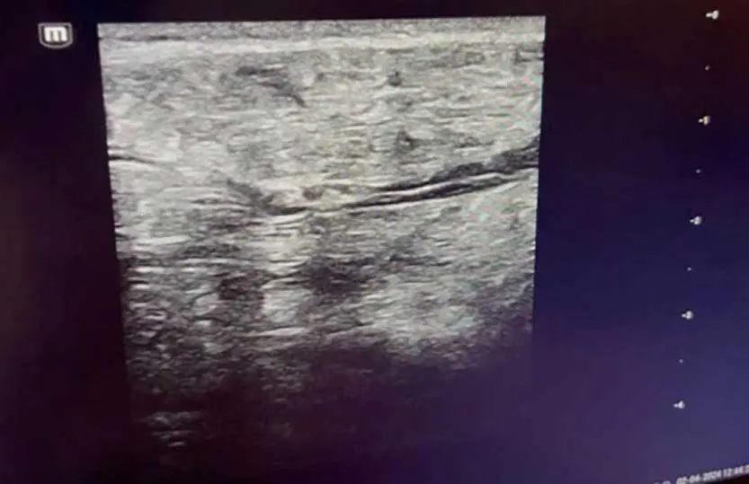 Figure 2. Ultrasound depth is adjusted to the level of the area of interest.