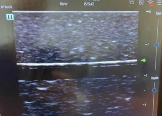 Figure 4. Ultrasound focus is adjusted to improve resolution of area of interest.