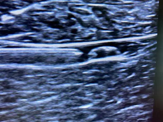 Figure 8. Stepping of the needle improves visualisation of the needle tip.