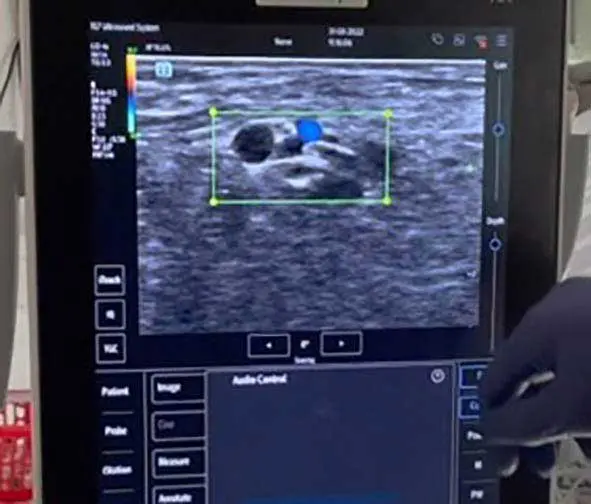 Figure 9. Circumferential spread of local anaesthetic around the nerve.