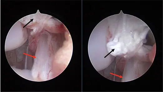 Figure 2: Arthroscopic images demonstrating complete tear of the caudal cruciate ligament (black arrow) and an intact cranial cruciate ligament (red arrow).