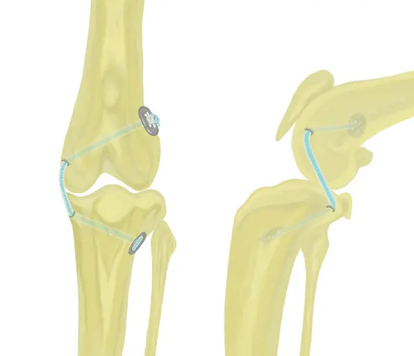 Figure 3: Schematic image showing an extra-articular Arthrex Tightrope used to stabilise a stifle with a ruptured caudal cruciate ligament. 