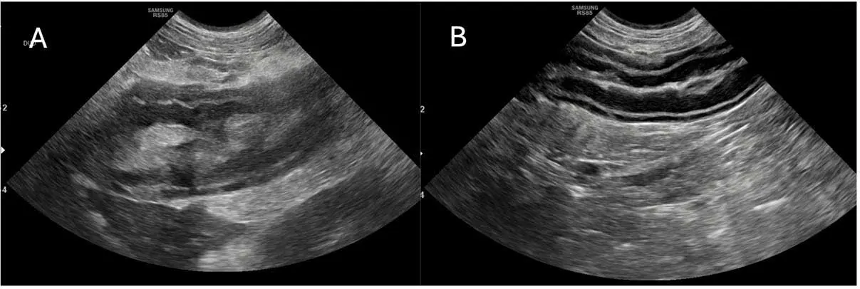 Figure 3. Ultrasonographic images of the duodenum in a dog with canine acute pancreatitis at different time points. A: at presentation; B: six days later when there has been significant clinical improvement). In A, the duodenum adjacent to the pancreas is markedly transmurally thickened and corrugated. In B, the duodenum is focally thickened but much improved. Image: Courtesy of Jinjing He