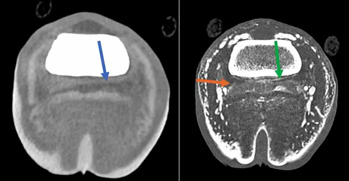 Figure 3. Transverse images of the left forelimb, in the region of the proximal recess of the navicular bursa. A large synovial mass associated with the lateral lobe of the deep digital flexor tendon (blue arrow) is present, which is markedly contrast enhancing (green arrow). Also, note the contrast enhancement of the navicular bursa (orange arrow).