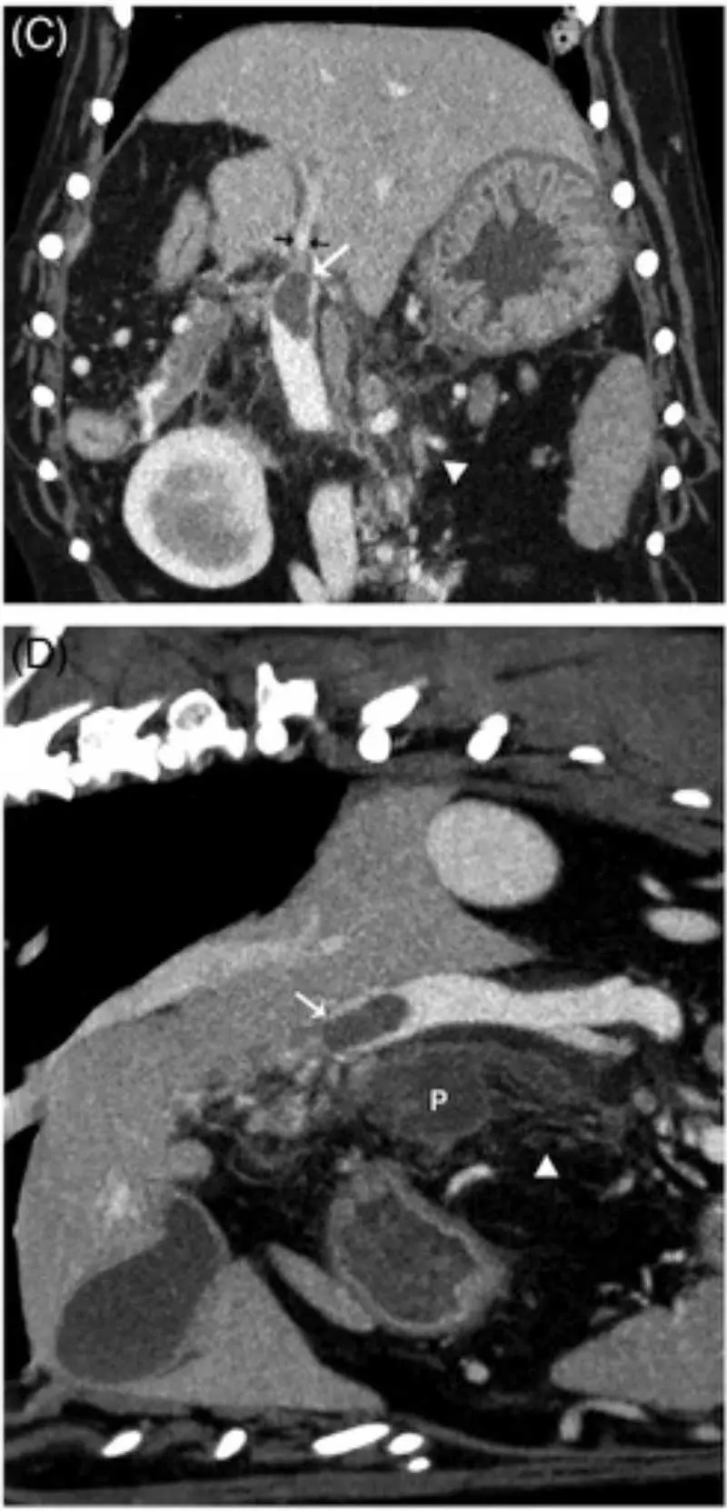 Figure 2. CT reconstructions from a dog in a venous phase. A large filling defect (white arrows) is present within the main portal vein adjacent to the body of the pancreas (P), with marked tapering of the portal vein cranial to the filling defect likely indicating occlusion (black arrows). Reproduced with permission18.