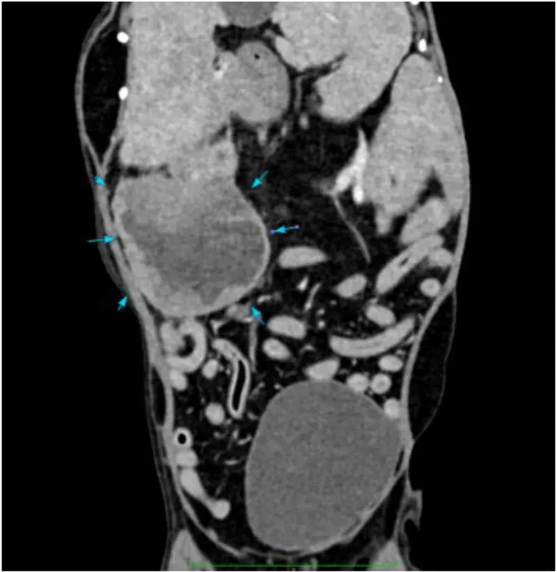 Figure 3. CT reconstruction of a dog with a rounded fluid-attenuating mass in the caudal right limb of the pancreas measuring 7×6cm (blue arrows). The peritoneal fat adjacent to the mass is slightly increased in attenuating suggesting peritonitis. Cytology from the mass revealed marked neutrophilic inflammation. Image: Courtesy of Jinjing He