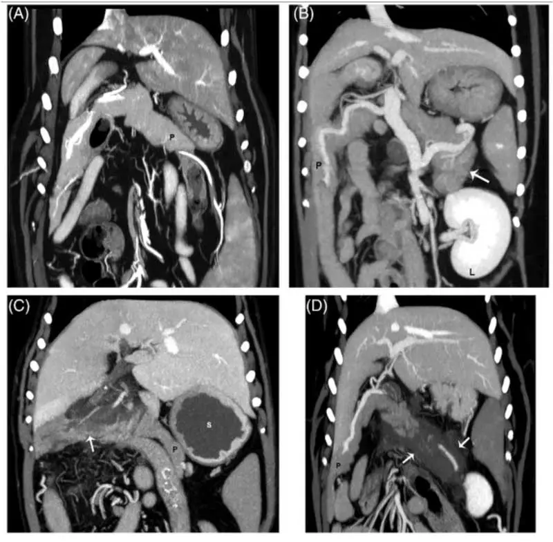 Figure 4. CT reconstructions from the pancreas from different dogs in venous phase. A: Comparison of a normal pancreas (P); B: pancreas with homogeneous contrast enhancement and thickening of the left lobe (white arrow); C: pancreas with heterogeneous contrast enhancement (arrow) of the mid body, D: pancreas with a severe form of heterogeneous contrast enhancement (arrows). Notice the fluid-filled stomach (s), likely indicating gastric ileus in C. Reproduced with permission 18.