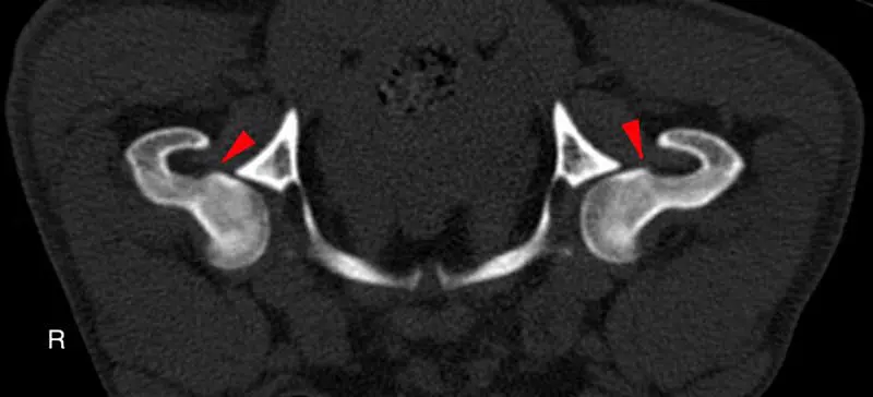 Figure 3. Advanced imaging such as CT can demonstrate earlier evidence of OA. In this patient, mild bilateral coxofemoral osteoarthrosis is present with faint osteophytes along the femoral heads (red arrows). Image: VetCT