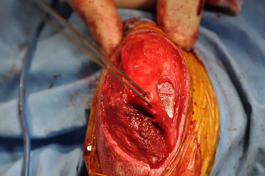 Figure 2. Tibial tuberosity transposition demonstrated in intraoperative photographs taken from cranial. Orientation: the stifle is flexed to 90° and the thigh is braced between gloved fingers and thumb. Cranial tibial muscle has been elevated to the left side of the images. The tibial tuberosity has been elevated and lateralised, leaving a flat surface of osteotomised proximal tibial metaphysis exposed to the right. Two Kirschner wires have been driven from cranial to caudal to stabilise the tibial tuberosity. Fixation will be augmented with a figure of eight tension band wire passed over the proximal Kirschner wire and through a bone tunnel in the proximal tibial diaphysis, then the wires will be bent over and cut short to complete the procedure.