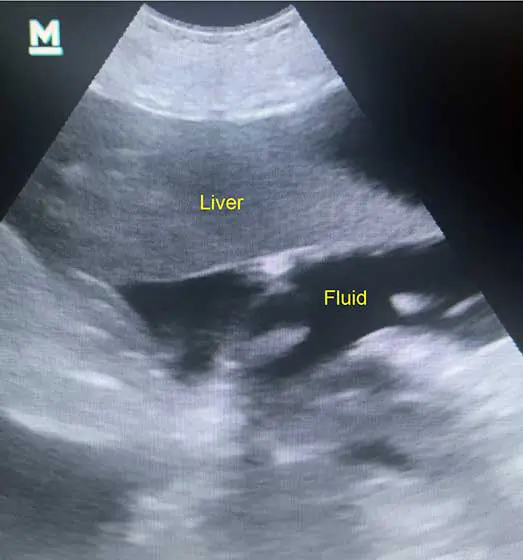 Abdominal ultrasound showing medium volume of abdominal free fluid. Anechoic pockets are noted between viscera.