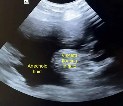 Abdominal ultrasound showing large volume of abdominal free fluid. Viscera can appear to float within the anechoic spaces.