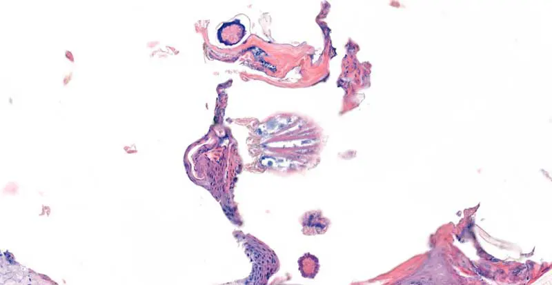 Figure 2. Sarcoptes scabiei, skin. Adult mite measuring approximately 135 × 115µm with a approximately 2µm chitinous exoskeleton, dorsal spines, jointed appendages, striated musculature, and body cavity (hemocoel). Haematoxylin and eosin.