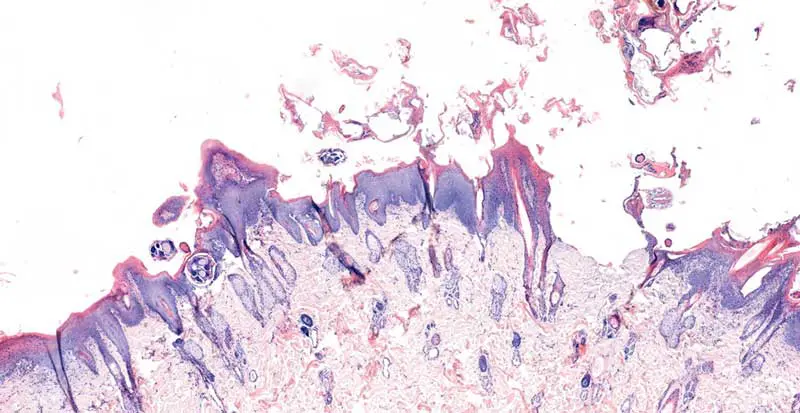 Figure 1. Sarcoptes scabiei, skin. Epidermis with moderate to marked acanthosis and orthokeratotic and parakeratotic hyperkeratosis. Multiple adult mites are present within the superficial stratum corneum and epidermis. Haematoxylin and eosin.