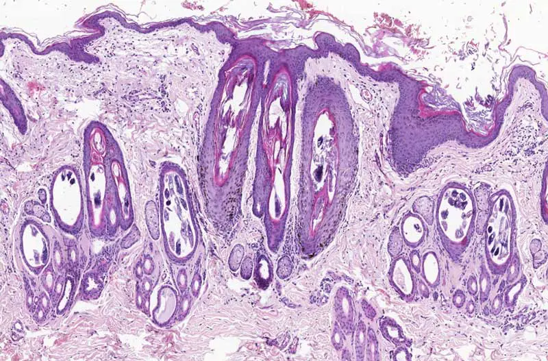 Figure 3. Demodex canis, skin. Multiple intrafollicular sections of mites. The epidermis shows mild to moderate hyperplasia with parakeratotic hyperkeratosis. The dermis contains mild to moderate lymphoplasmacytic inflammation. Haematoxylin and eosin.