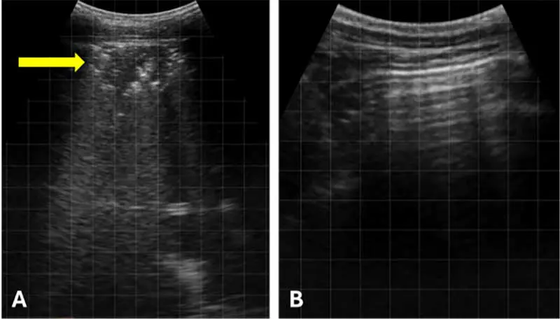 Figure 1. Thoracic ultrasound can be used to detect lung lesions such as that in figure A (yellow arrow). A = lung lesion indicated by yellow arrow. B = healthy lung tissue identified by the reverberation artefact (horizontal “A” lines) caused by the presence of air. Both images were obtained using an IMV Easi-Scan:Go curve bovine ultrasound scanner.