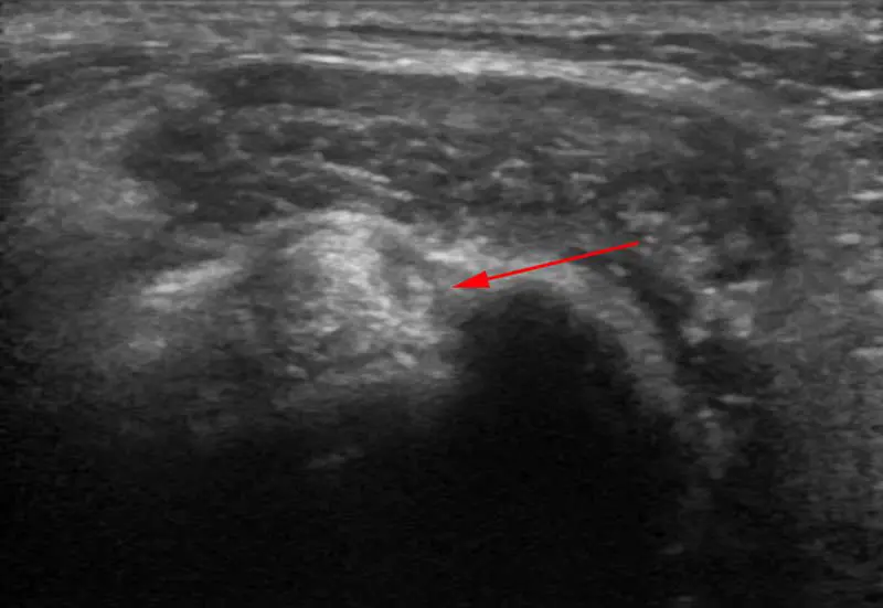 Figure 4. Ultrasound in this case of suspected elbow pathology demonstrated tendon heterogeneity together with increased fluid in the tendon sheath.