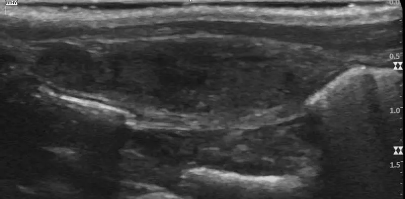 Figure 5. A cervical scan identified an enlarged and heterogeneous right thyroid gland in this patient.