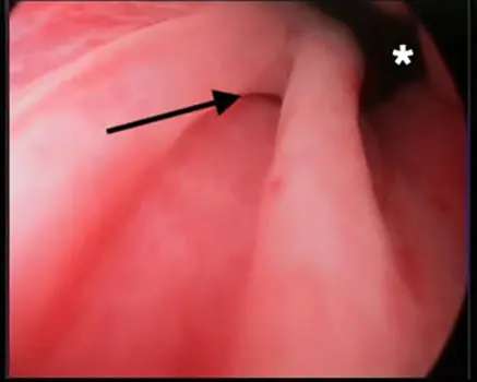 Figure 2. An endoscopic image of an ectopic ureter obtained with a rigid scope in a female dog. The black arrow shows the ectopic ureter and the asterisk shows the urethral lumen.