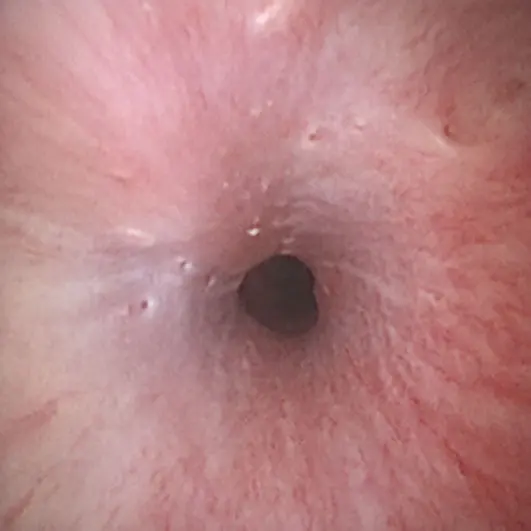Figure 7. An endoscopic image of the prostatic urethra showing the small prostatic ducts present.