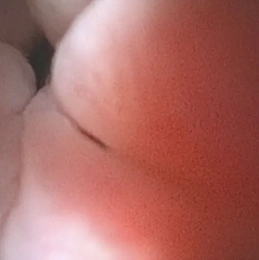 Figure 8. An endoscopic image of a stenotic ectopic ureterovesicular junction in a male dog.