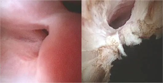 Figure 9. Two endoscopic images during ablation of an ectopic ureter. Note the progressing opening of the ureter once the initial stenotic portion is ablated.