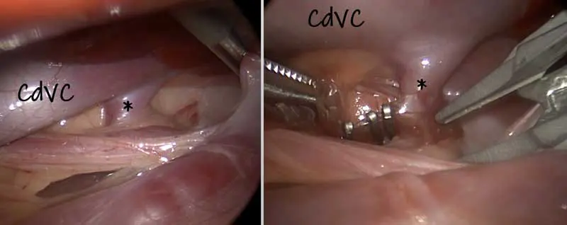 Intraoperative images showing the extrahepatic portosystemic shunt (asterisk) before (left) and after (right) laparoscopic cellophane band placement.