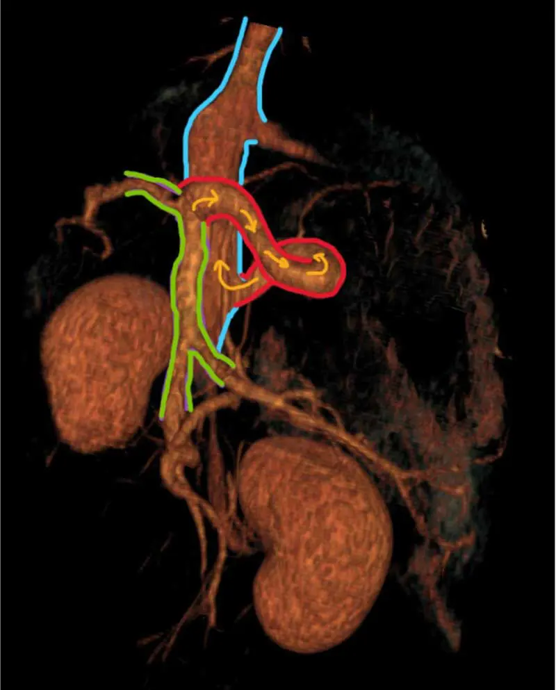 Preoperative CT 3D render showing the shunting vessel (red) arising from the right gastric branch of the portal system (green) and entering the caudal vena cava (blue) in the epiploic foramen.