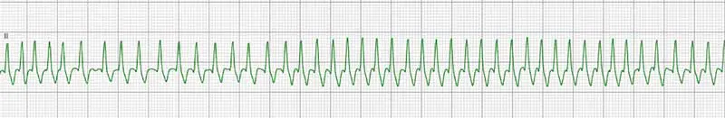 Figure 1. Atrial fibrillation in a dog.