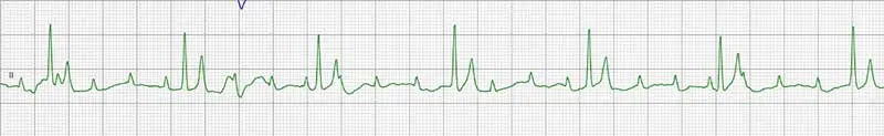 Figure 2. Complete atrioventricular block.