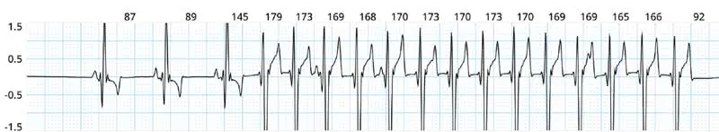 Figure 3. Intermittent ventricular tachycardia on Holter.