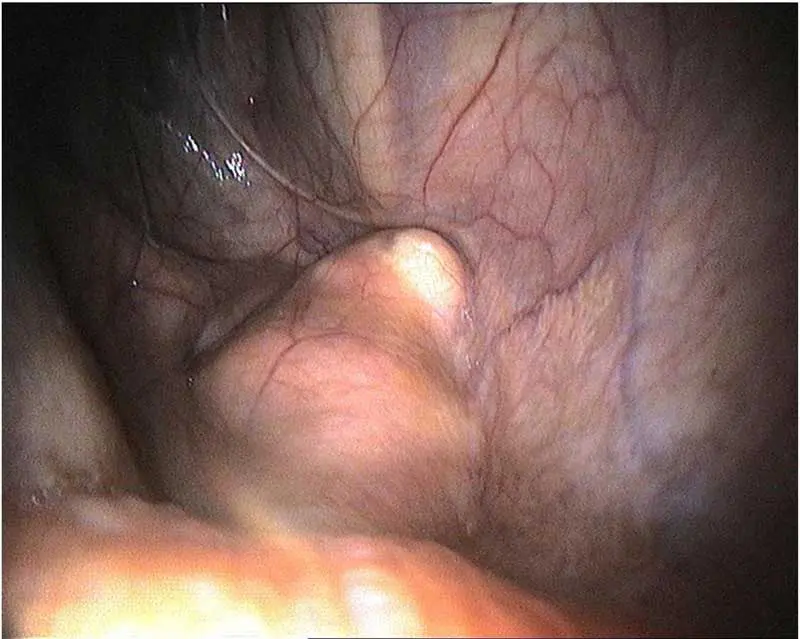 Figure 3. Retropharyngeal lymph node about to rupture into the guttural pouch. Note that this does not happen in all cases, but will lead to temporary or persistent guttural pouch infection.